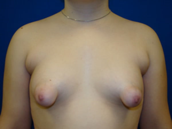 Puffy nipples strip