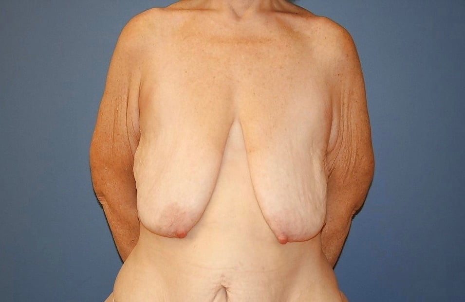 Saggy Tits Extreme-A VERY FLAT Pair.