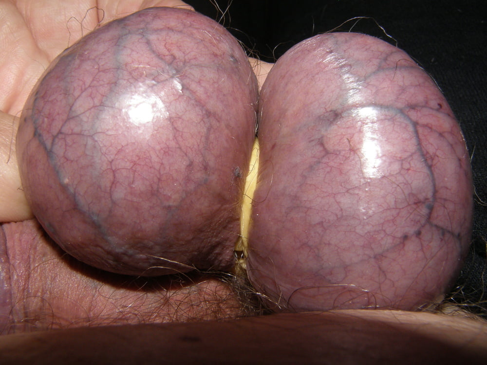 Testicle Removal 14 Pics Xhamster