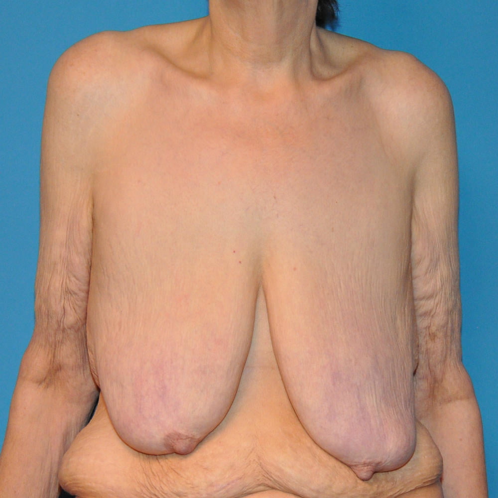 Super Saggy Tits Breast Reduction 2 Pics Xhamster 2928