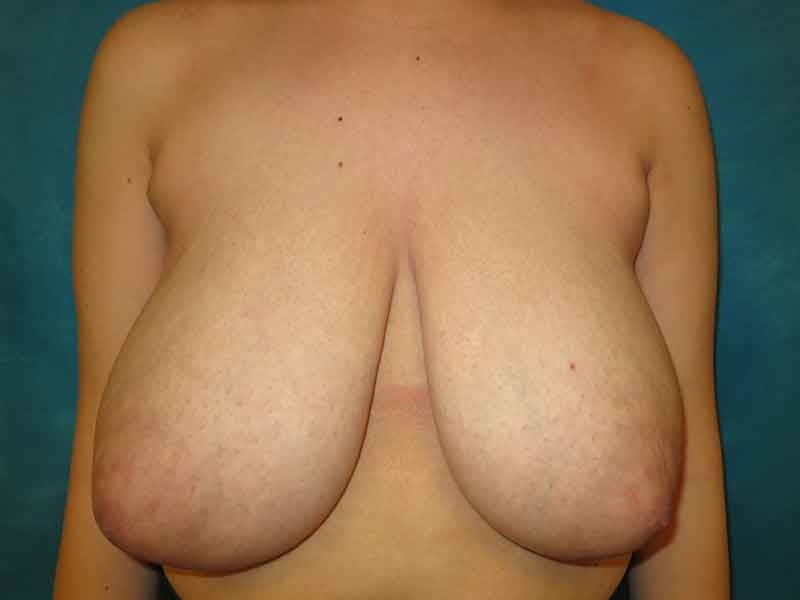 Breast reduction surgery after mastectomy-6789